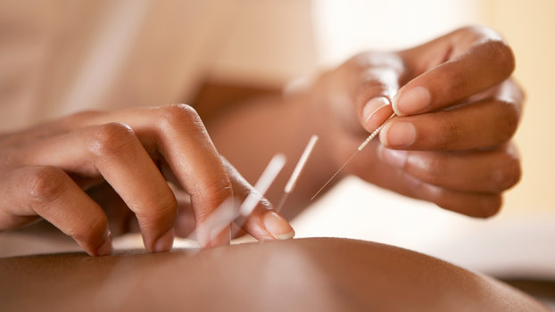 acupuncture